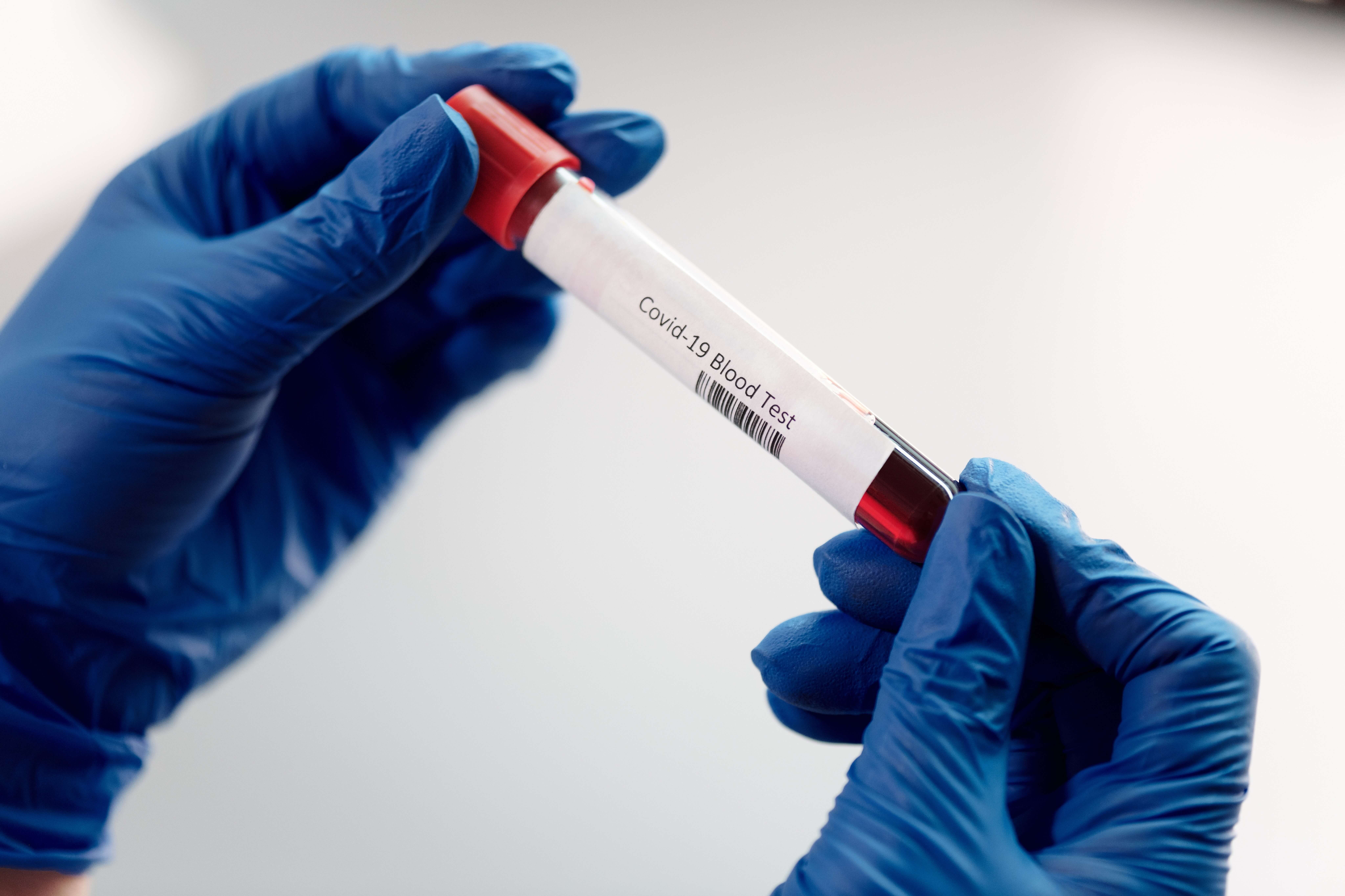 Blood Test Aims to Measure COVID Immunity